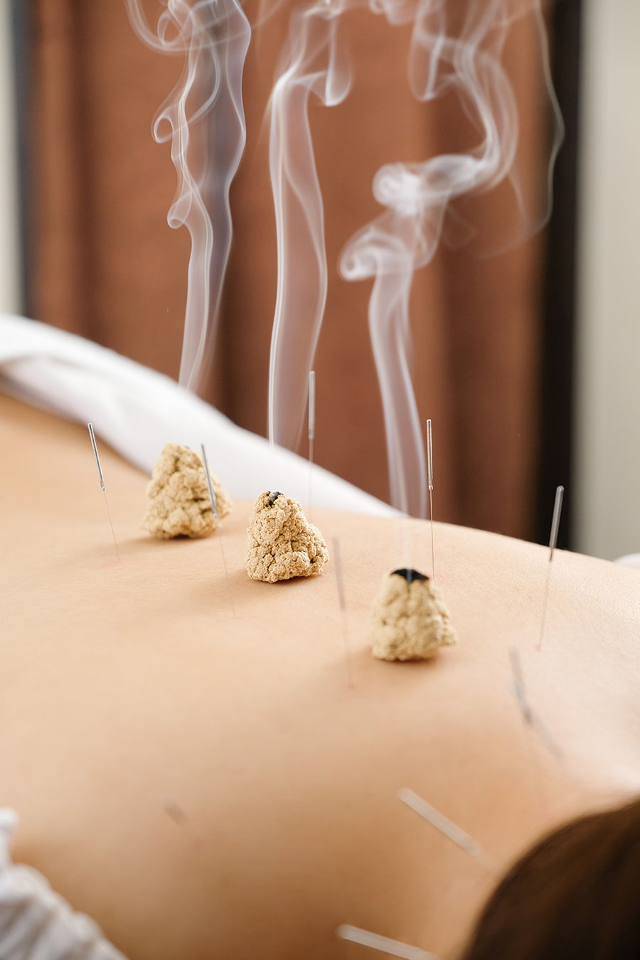 moxibustion zaragoza acupuntura