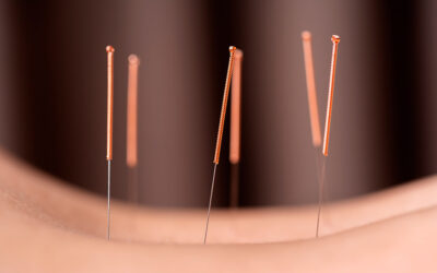 Qué es la acupuntura