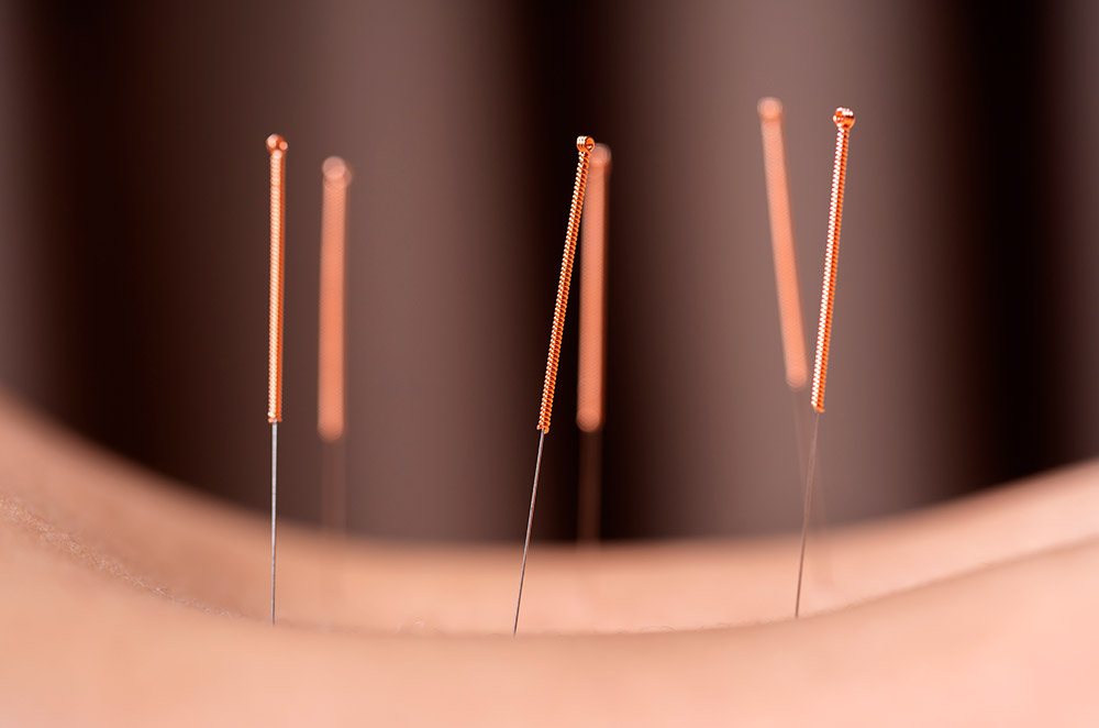 Qué es la acupuntura
