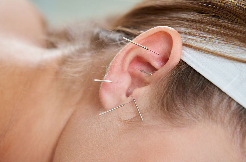 ¿Qué es la auriculoterapia?