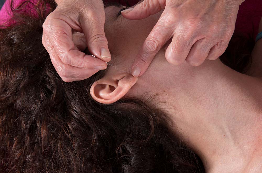 Cómo dejar de fumar con acupuntura Cómo dejar de fumar con acupuntura